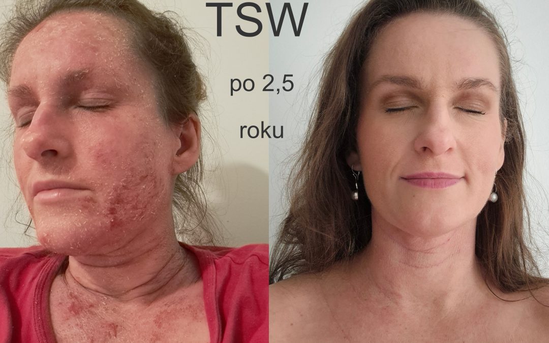 Stav TSW po 2,5 roku